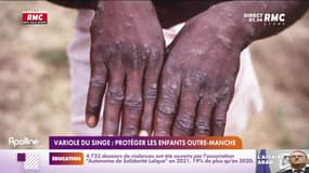 La variole du singe progresse en Europe: 20 cas recensés au Royaume-Uni