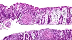 La maladie de Crohn crée de graves inflammations intestinales, et peut se détecter grâce à une biopsie du colon.