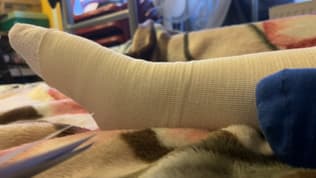 Illia, neuf ans, vient de subir une greffe de peau après s’être grièvement blessé le pied et la fesse au contact d’un radiateur à une température anormalement élevée à Francheville.