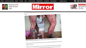 Les parents d'une fillette portant une tache de naissance sur la jambe, se sont fait tatouer pour lui ressembler. 