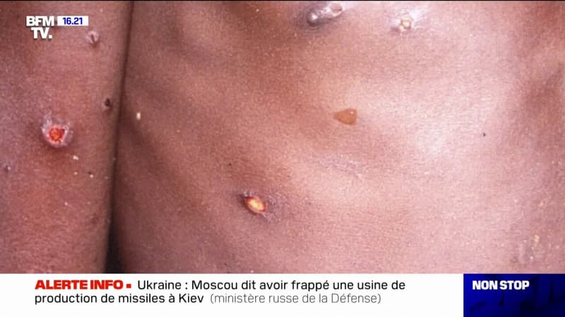 Regarder la vidéo Premier cas de variole du singe infantile en France: 