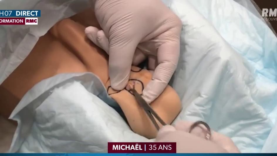 Le nombre de recours à la vasectomie explose en France