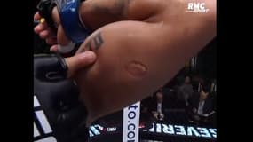 L'impressionnante marque de la morsure d’Igor Severino sur le bras d'Andre Lima