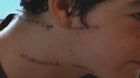Les blessures de Dylan ont ont nécessité 52 points de sutures.