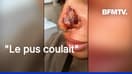  "Elle m'a dit que c'était l'hématome": les injections illégales de botox font des ravages 