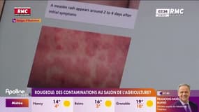 Le Salon de l’Agriculture à l’origine d’une recrudescence de la rougeole