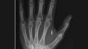 La puce RFID dans la main du magicien Zi Teng Wang. 