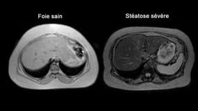 Échographie d'un foie sain et d'un foie atteint du premier stade de la NASH. 