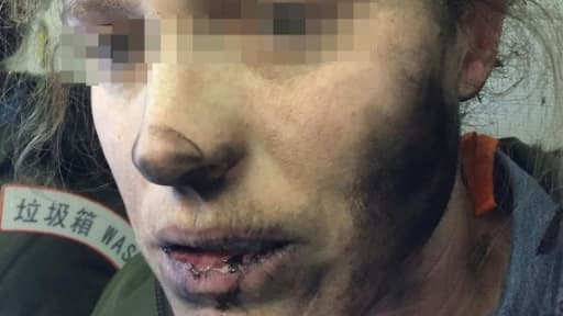 Photo prise le 19 février 2017 d'une Australienne brûlée au visage et au cou par ses écouteurs qui ont pris feu durant un vol entre Pékin et Melbourne