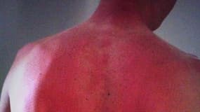 Gros coup de soleil pour Froome
