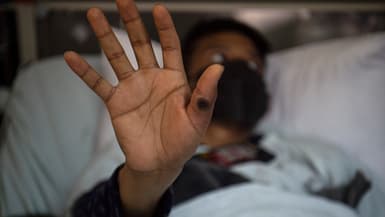 Un patient touché par le virus mpox, la "variole du singe", dans un hôpital de Lima (Pérou), le 16 août 2024.