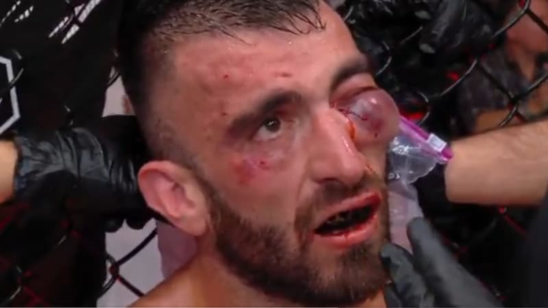 UFC Abu Dhabi: l'image folle de l'énorme bosse sous l'oeil d'un combattant émirati