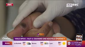 Virus Mpox : faut-il craindre une nouvelle épidémie ?