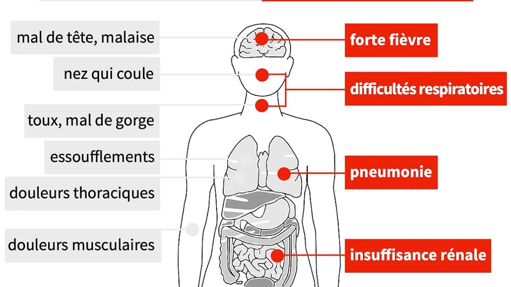 Symptôme Coronavirus Symptôme Coronavirus