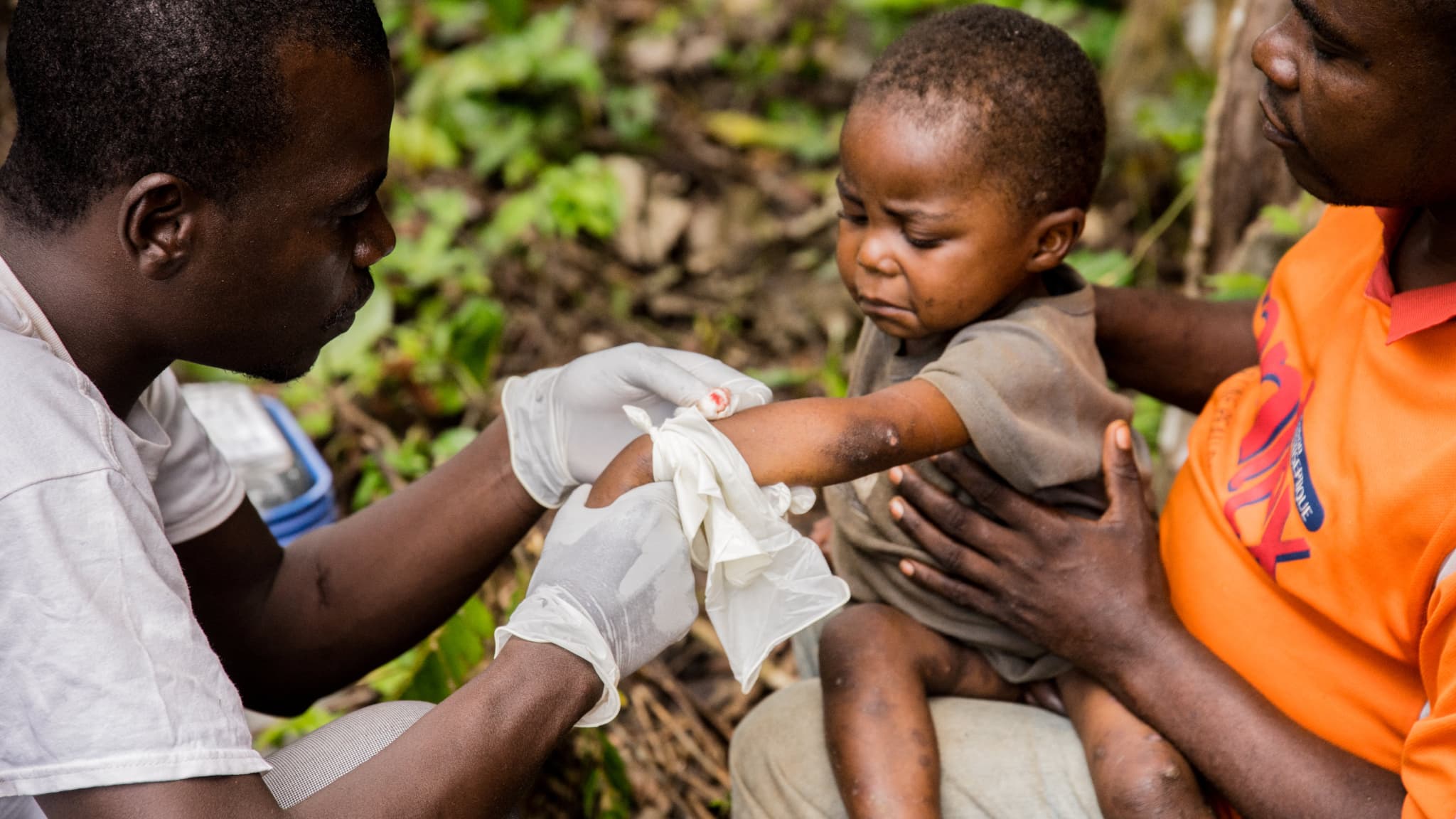 Un enfant atteint de la variole du singe en République centrafricaine, en 2018