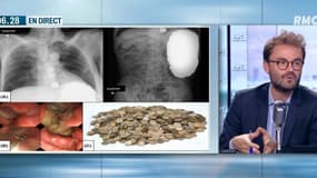 Les médecins découvrent 1894 pièces dans son estomac
