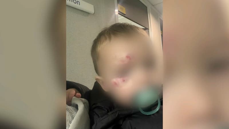 "Il avait le visage gonflé": des parents récupèrent leur fils blessé à la crèche et portent plainte