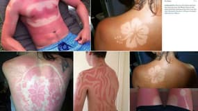 Le Sunburn art qui consiste à faire apparaître des motifs sur la peau en attrapant des coups de soleil est dangereux pour la santé.