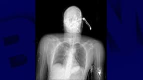 La radiographie de la victime après son agression à Dijon, le 3 juillet 2021.