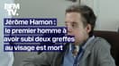 Jérôme Hamon, le premier homme avec deux greffes au visage est mort