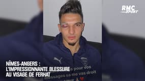 Nîmes-Angers: L'impressionnante blessure au visage de Ferhat 