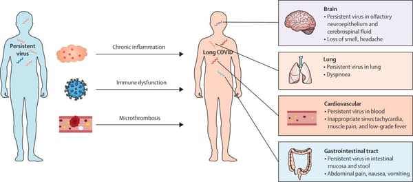 Exemples de COVID longs qui pourraient être entraînés par la persistance du SARS-CoV-2 dans l'organisme, selon une étude de The Lancet