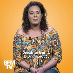 Atteinte du vitiligo depuis ses cinq ans, elle l'assume aujourd'hui pleinement.