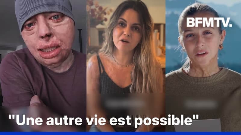 Des grands brûlés envoient un message d'espoir aux victimes et proches de Crans-Montana