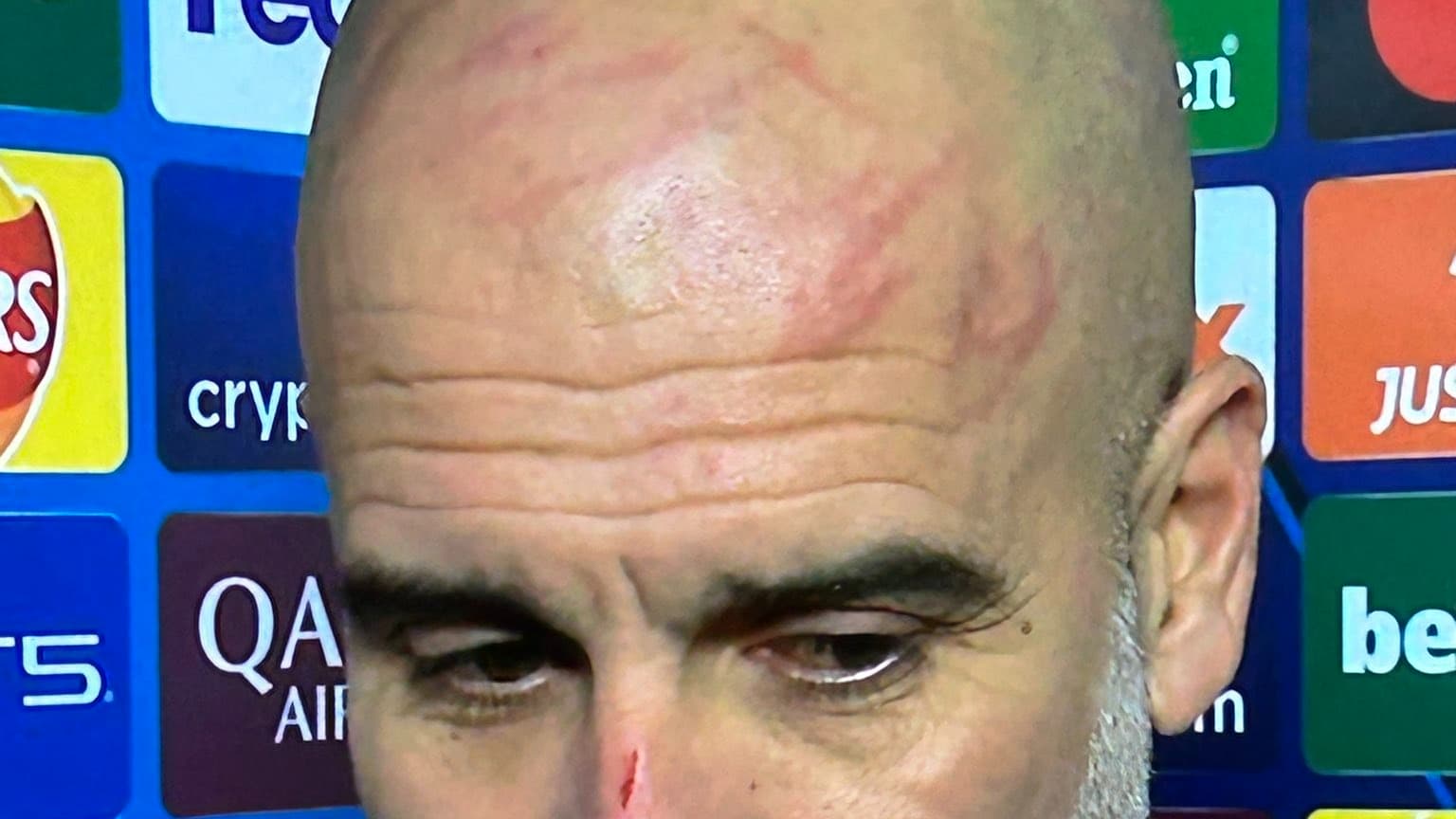 Manchester City: "Je voulais me faire du mal", Guardiola justifie ses nombreuses griffures au visage dans une séquence surréaliste - le 26/11/2024