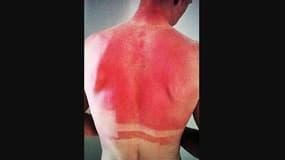Christopher Froome victime d'un violent coup de soleil en 2014