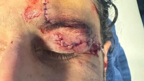 Fabio Grosso s'est fait posé 12 points de suture après le caillassage du bus lyonnais avant OM-OL  (document RMC Sport)