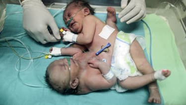 Des sœurs siamoises le 22 octobre 2017 à l'hôpital Al-Shifa à Gaza