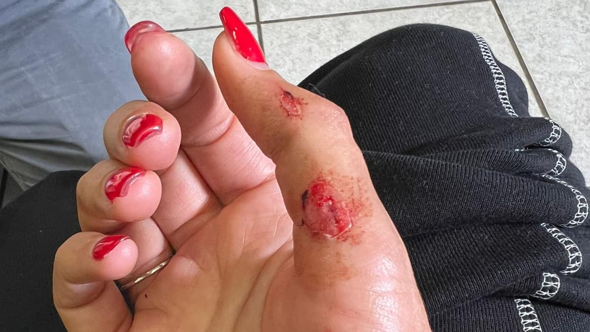 Les blessures de Kheira Hamraoui, agressée le 4 novembre 2021