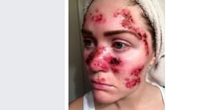 Tawny Willoughby, atteinte d'un cancer de la peau, a posté un selfie de sa peau défigurée pour alerter sur les dangers des cabines à UV.