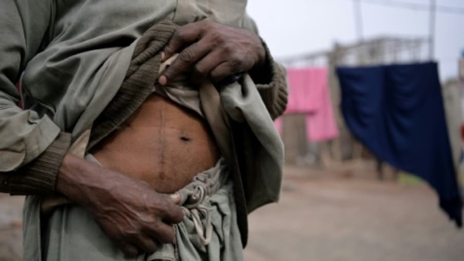Un homme ayant vendu un rein montre sa cicatrice à Bhalwal au Pakistan, le 2 février 2017