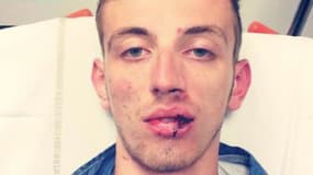 Raphaël a posté la photo de son visage tuméfié après l'agression sur son compte Facebook.