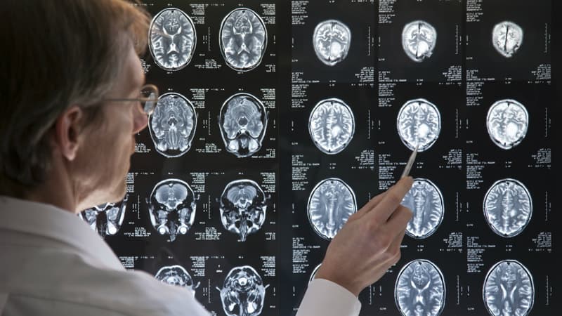 La sclérose en plaques est une maladie auto-immune qui affecte le système nerveux central.