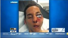 Le journal Le Parisien publie ce vendredi matin la photo du jeune homme blessé à l'oeil par une balle de flashball tirée par un policier.
