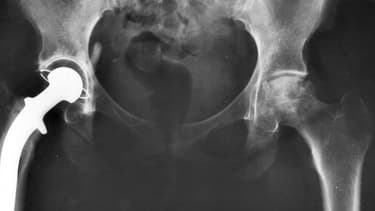 Radiographie d'une prothèse de hanche (photo d'illustration)