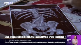 Marseille: une pince chirurgicale de 20 centimètres a été oubliée dans l'abdomen d'un patient