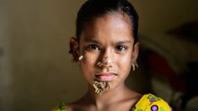 Sahana Khatun, 10 ans, serait le premier cas de femme-arbre