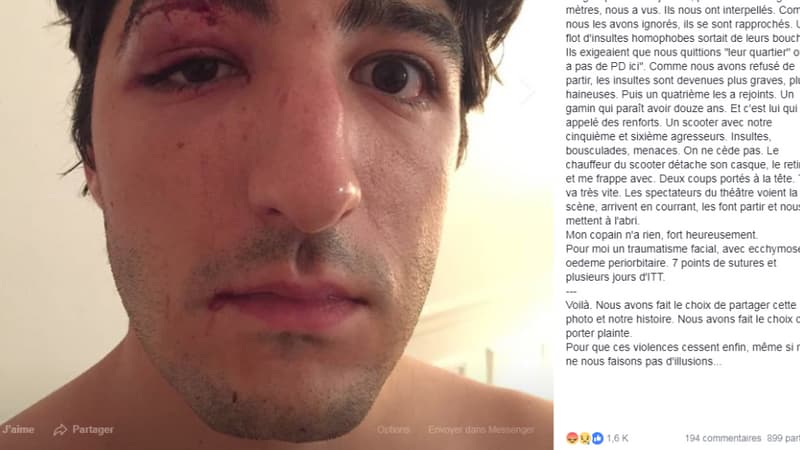 Victime d'une agression homophobe, Arnaud Gagnoud écope de sept points de suture et de plusieurs jours d'ITT. 