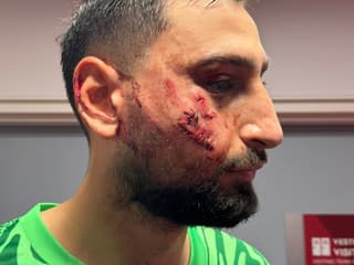 Ligue 1 - Monaco-PSG - Gianluigi Donnarumma gravement blessé au visage