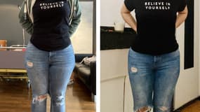 La jeune femme avant sa première opération (gauche), puis après (droite).