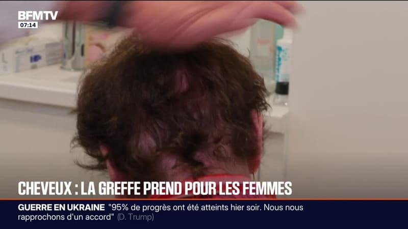 Les femmes sont de plus en plus nombreuses à avoir recours à la greffe de cheveux