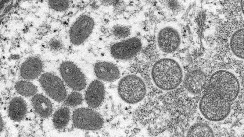 Les États-Unis déclarent l'épidémie de variole du singe urgence de santé publique