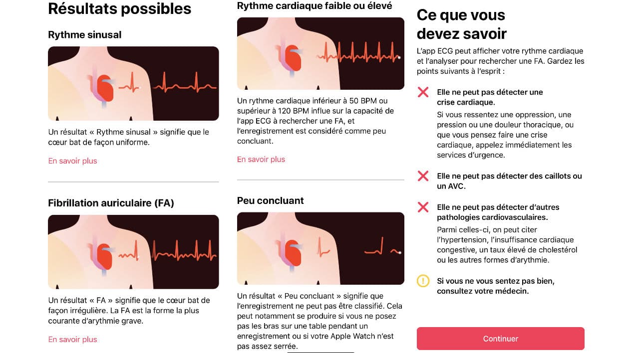 quoi sert l ECG la nouvelle fonction de l Apple Watch