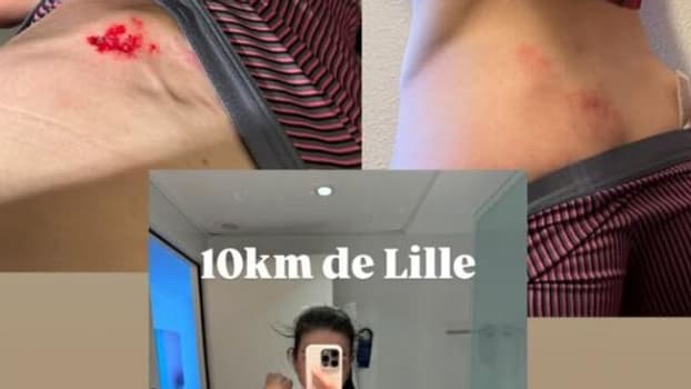 Les stigmates d'Emma Lombardi après sa chute au départ du 10km de Lille, le 16 mars 2025 Les stigmates d'Emma Lombardi après sa chute au départ du 10km de Lille, le 16 mars 2025
