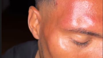 Niklas Sommer a dévoilé ses blessures dans une story sur Instagram la nuit dernière