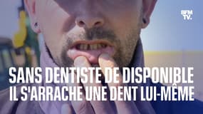 Charente-Maritime: faute de dentiste disponible, il s'arrache une dent lui-même